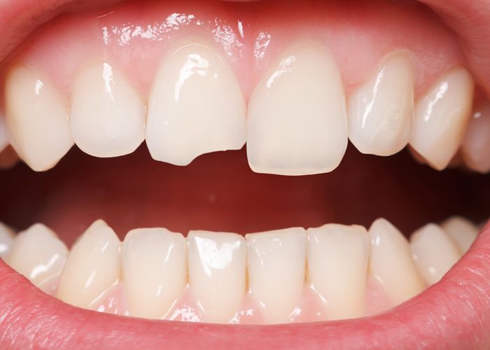 Chipped front tooth