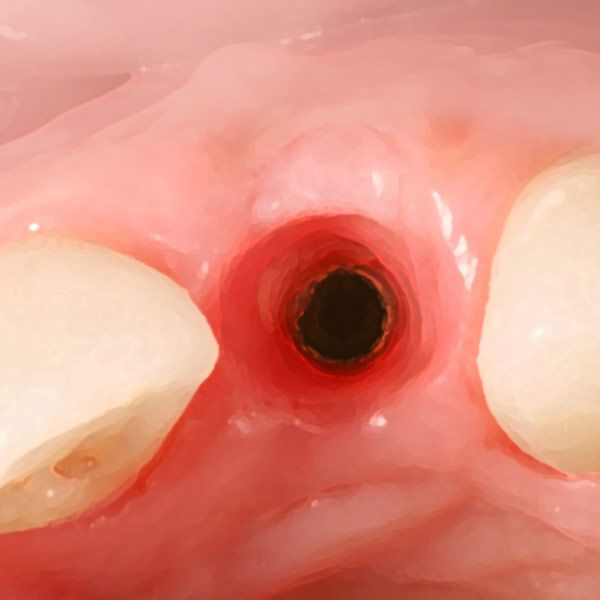 Socket bone graft